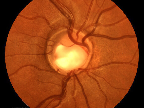 Glaucoma Figure 3