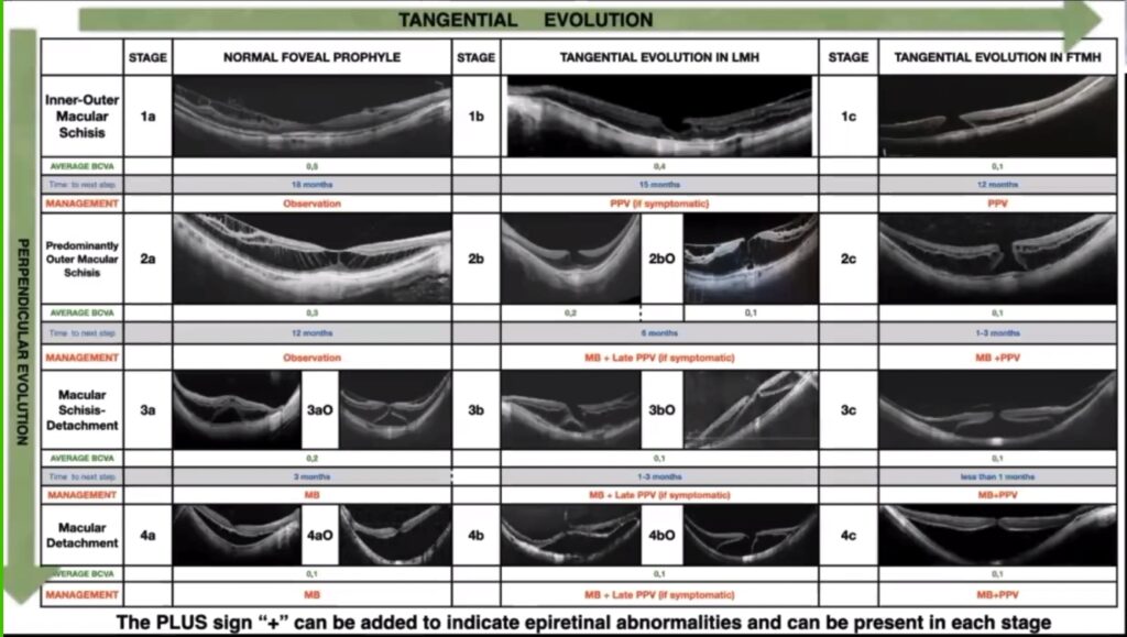 Staging and Managing Myopic Traction Maculopathy