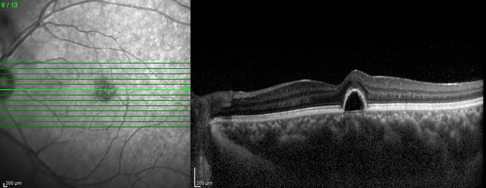 Optical,Coherence,Tomography,(oct),Image,Of,Eye,In,The,Patient