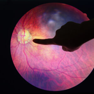 The Deal About DR: Retinal Surgeons Give Their Two Cents’ Worth on Diabetic Retinopathy Management