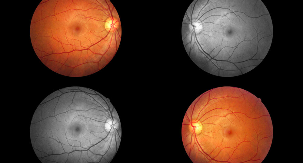 Human,Eye,Anatomy,Taking,Images,With,Mydriatic,Retinal,Cameras