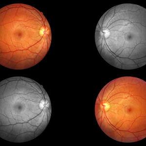 Two Rival Treatments Approved for Geographic Atrophy Under the Spotlight
