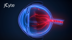 first-patients-treated-in-jCyte_Thumbnail