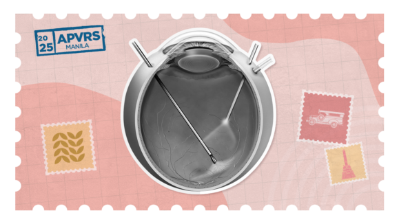 APOT-APVRS session on management of posterior segment trauma